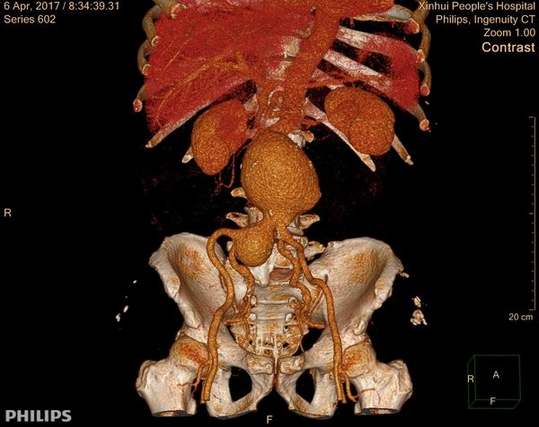 我院成功抢救一名腹主动脉瘤破裂患者