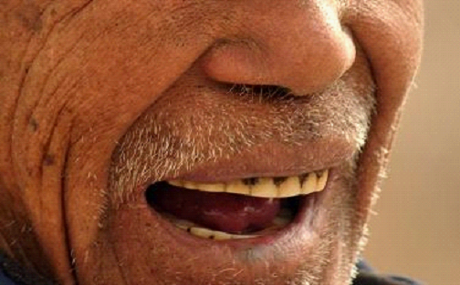 老人掉牙不镶牙当心老年痴呆 糖尿病不宜种植牙