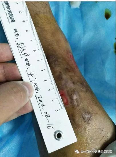 二型糖尿病足