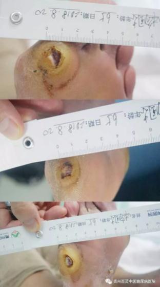 糖足伤口