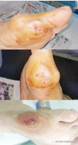 糖足治疗效果