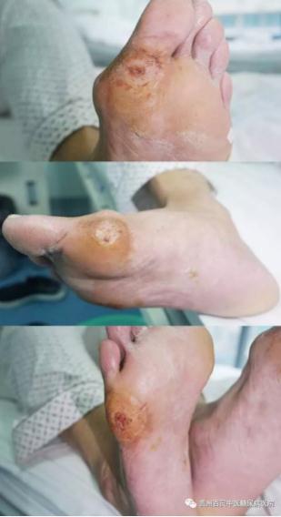 糖尿病足痊愈效果