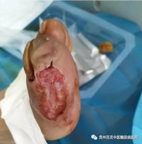 糖尿病足溃烂