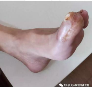 糖足治疗恢复