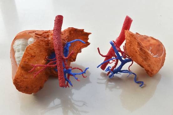3d打印肝脏模型(图左为术前荷瘤肝脏,图右为术后残肝)