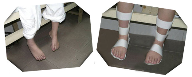 &emsp;&emsp;如腓总神经损伤后胫前肌无力致足下垂,踝背伸矫形器可